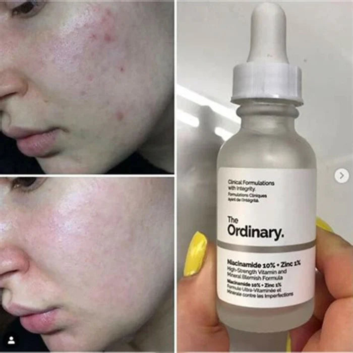 The Ordinary Niacinamide 10% + Zinc 1%, 30 ml  Smoothing Serum for Blemish-Prone Skin